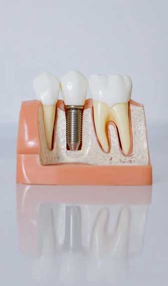 dental-implant-img