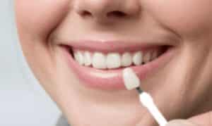 How to Transform Your Smile with Dental Veneers