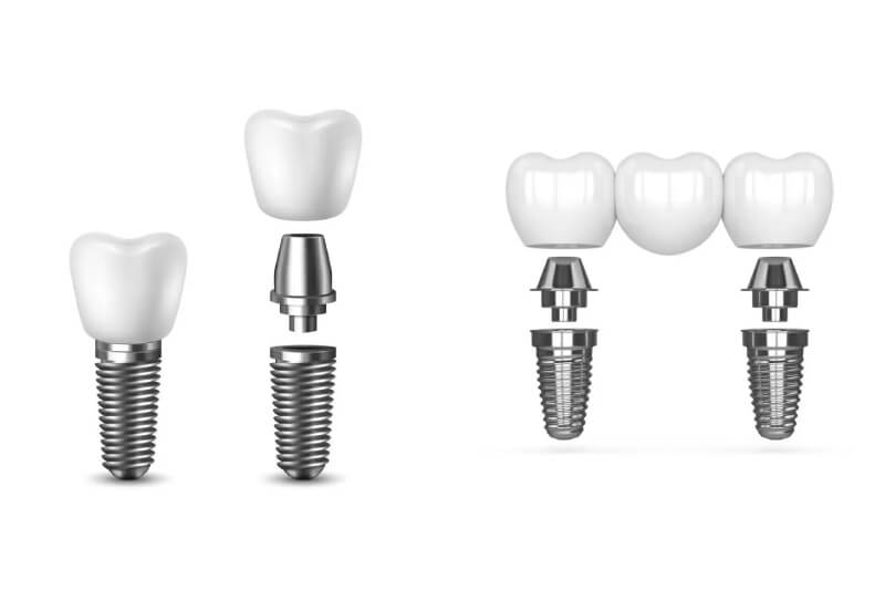 img-What Are Snap-In Implant Dentures