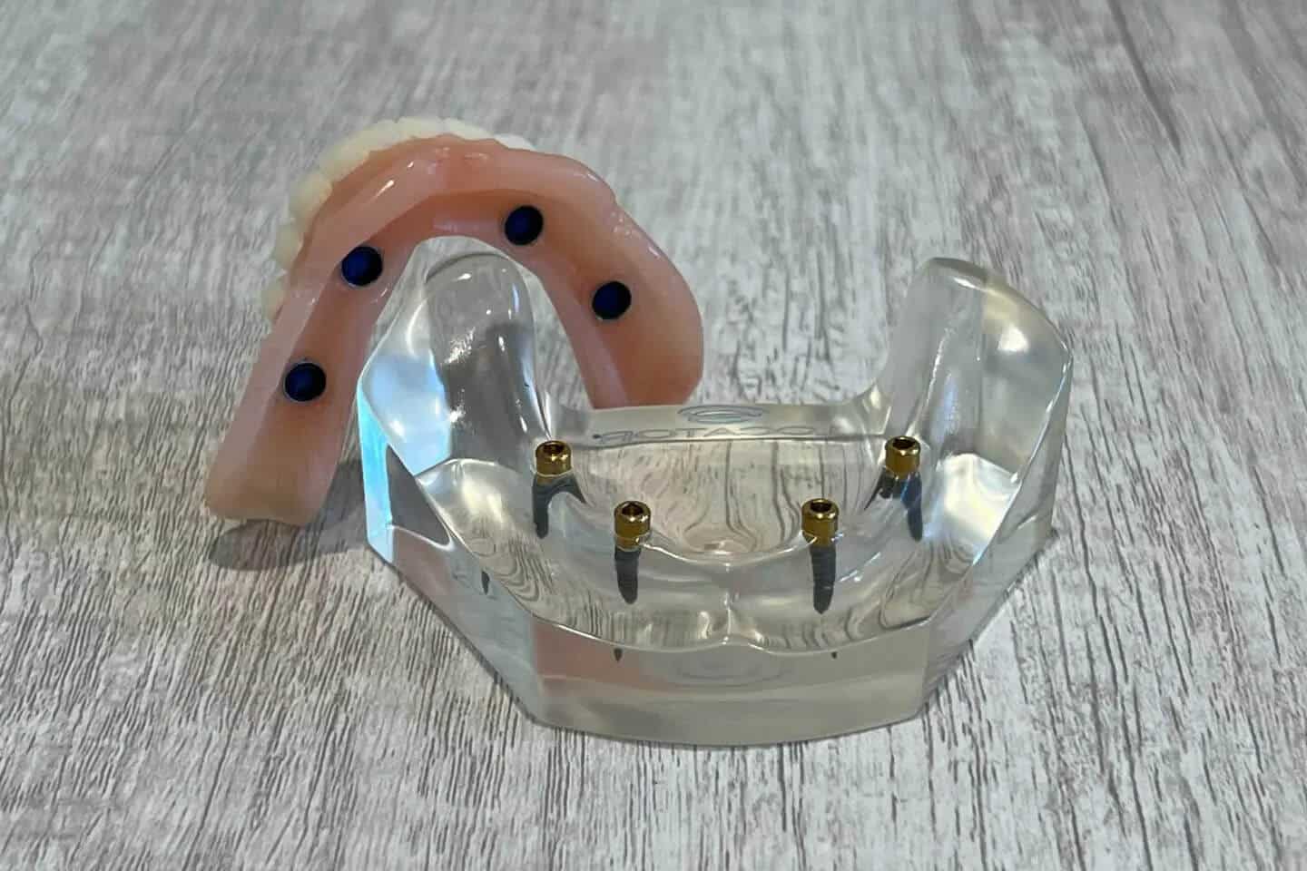 bnr-full-mouth-implant