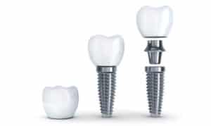 dental implant in magnolia-floss dental of magnolia, tx