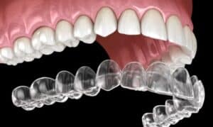 Image of how do invisalign dentist services work for you