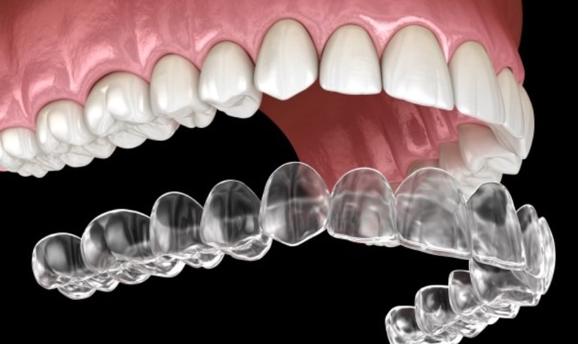 How Do Invisalign Dentist Services Work For You?