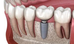 graphical image of dental implants-key factors that affect the success of dental implants