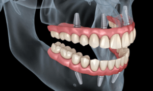 How long does it take to recover from full-mouth dental implant surgery
